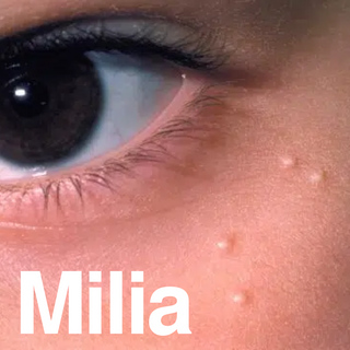 What Is Milia? How to Stop It and How to Treat It